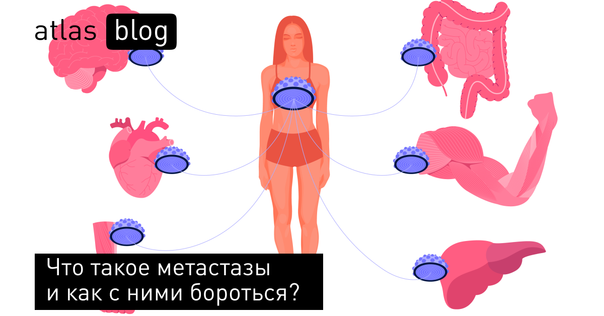 Рак кости - прогноз и лечение метастазов в костях при раке в Москве.