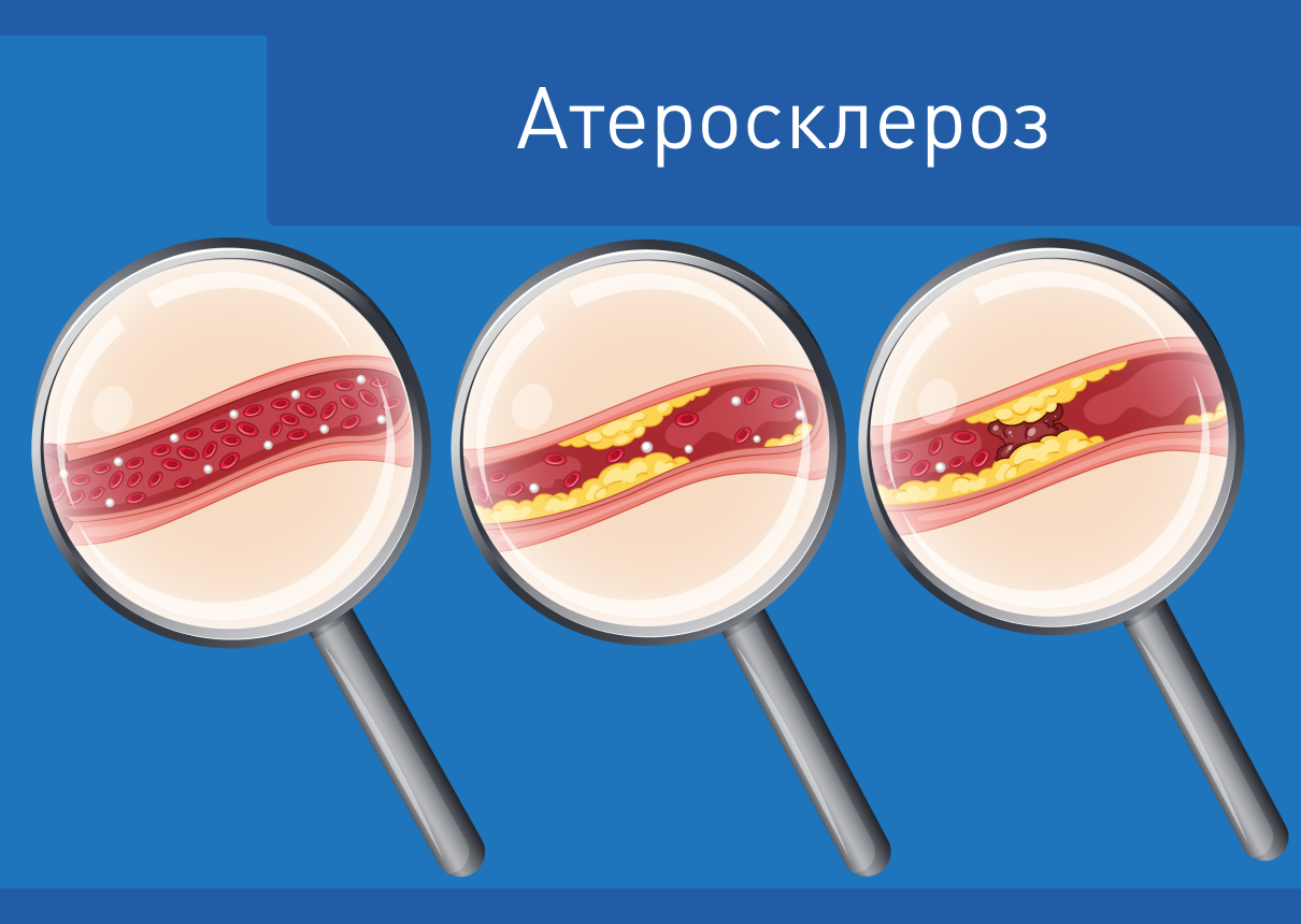 Воспаление и ССЗ