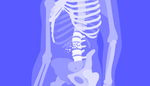 Остеопороз: как и почему кости становятся хрупкими