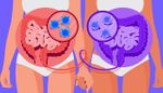 Трансплантация кишечной микробиоты: как и зачем?